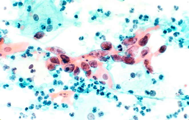 1280px-Cytological_specimen_showing_cervical_cancer