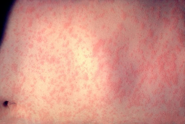 2048px-Morbillivirus_measles_infection