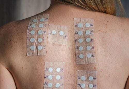 allergy-skin-testing