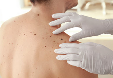 dermatologist-looking-at-dark-skin-irregularity