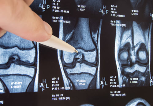 knee-needing-orthopedic-surgery