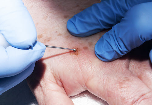skin doctor dermatologists removing skin lesion