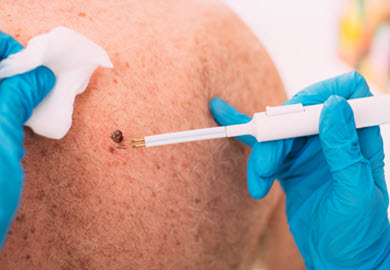 skin-doctor-removing-skin-lesion