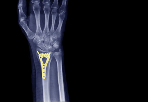 wrist-after-orthopedic-surgery