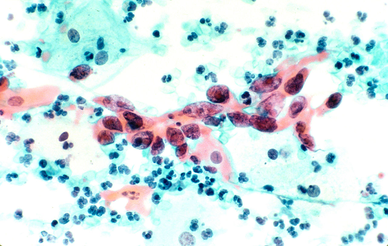 1280px-Cytological_specimen_showing_cervical_cancer