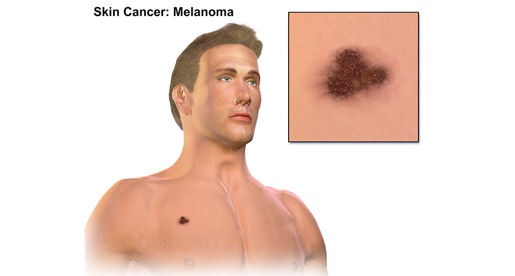RATE-OF-DEADLIEST-FORM-OF-SKIN-CANCER-IN-USA-RISES